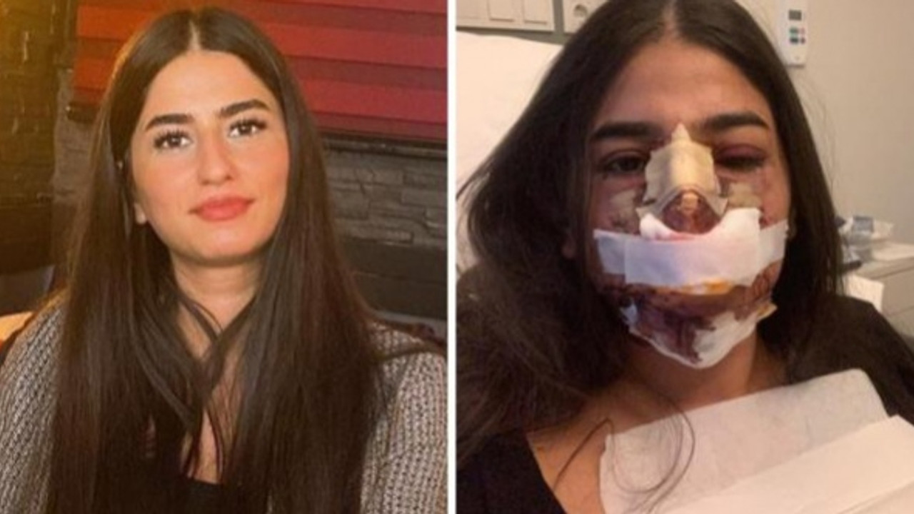 Burun estetiği yaptıran kadının hayatı karardı, pişkin doktor ise "Düğün hediyem olsun" dedi!