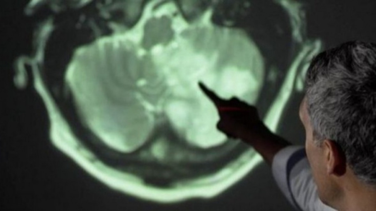 'Covid-19 geçirenlerin beyninde küçülme tespit edildi'