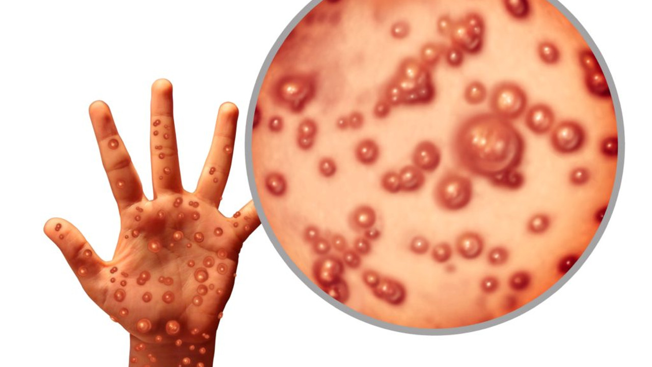 Maymun Çiçeği Virüsü (Mpox) nedir, nasıl bulaşır? Maymun Çiçeği Virüsü belirtileri neler, Türkiye'de var mı?