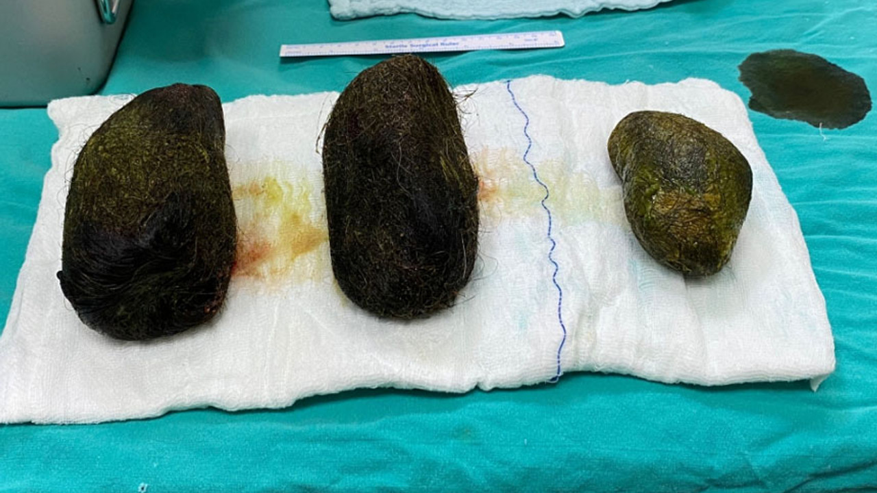 Karın ağrısı şikayetiyle doktora gitti: Midesinden çıkanlar şoke etti