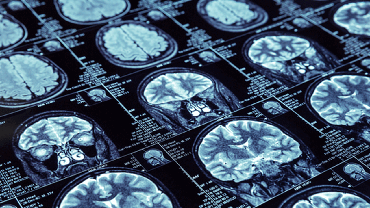 ODTÜ'lü bilim insanlarından yeni çalışma! Alzheimer'ı erken evrede tespit edilecek