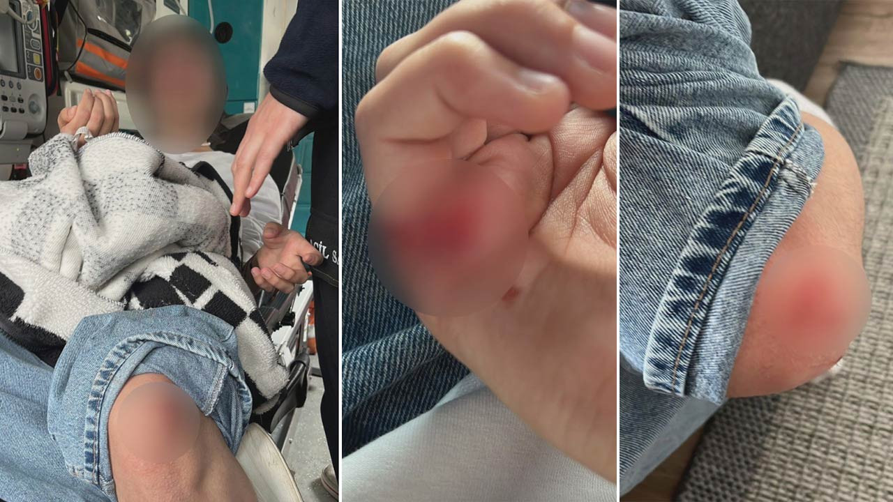 Mamak’ta bir çocuğa daha köpek saldırısı