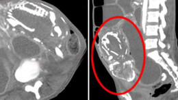 Şok vaka! Taşlaşan cenin, 50 yaşındaki kadını öldürdü
