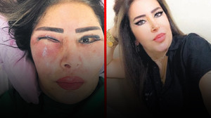 Estetik ameliyat faciası! Gözünün içinden et çıktı...