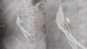 Mide ağrısı şikayetiyle gitti! İçinden çıkanlar doktorları bile şoke etti