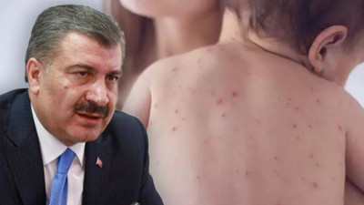 Bakan Koca’dan kızamık açıklaması: “Bir salgın durumu söz konusu değil”