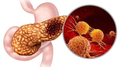 Akut Pankreatit nedir?