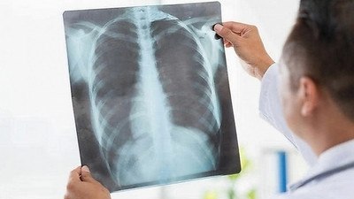 Pnömoni nedir? Pnömoni belirtileri, Pnömoni tedavi yöntemleri…
