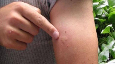 Dang humması nedir, belirtileri nelerdir? Dang humması hangi ülkelerde, Türkiye'de var mı? Dang humması tedavisi nedir?