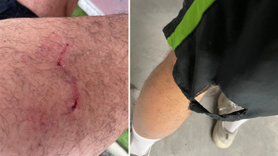 Sokak köpeklerinin ısırdığı sporcuya köpeksever kadından tepki!
