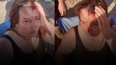 Denizde yüzen kadına, jet ski çarptı!