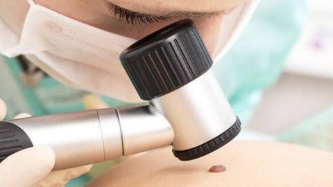 Vücutta hızla yayılıyorsa kanserin habercisi olabilir!