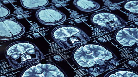 ODTÜ'lü bilim insanlarından yeni çalışma! Alzheimer'ı erken evrede tespit edilecek