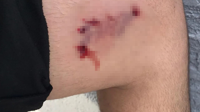 Hatay'da sokak köpekleri, saldırdığı çocuğa yaraladı