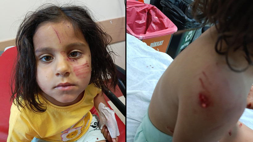 Sokak köpeklerinin saldırısına uğrayan çocuk yaralandı