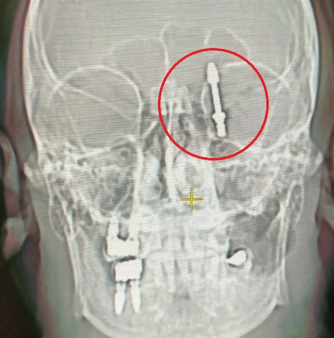 Bursa Implant 21042024 Iha (1)