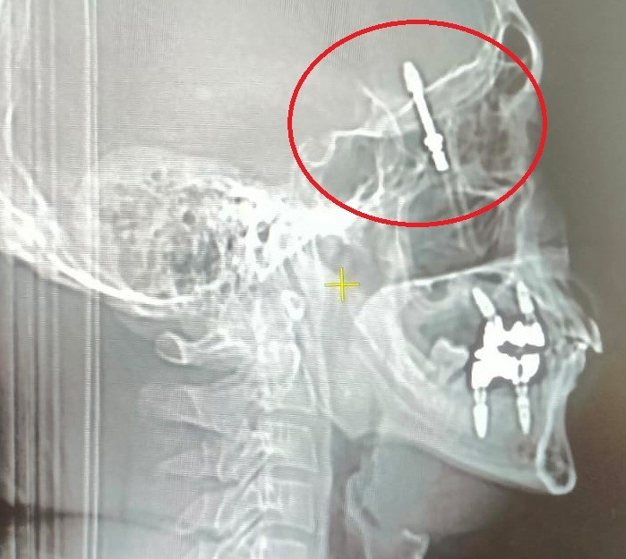 Bursa Implant 21042024 Iha (2)